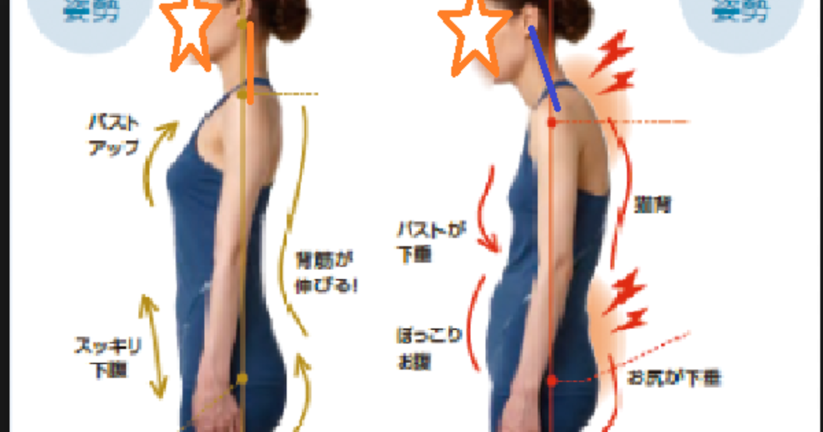 側弯症改善木型 側弯症改善木型